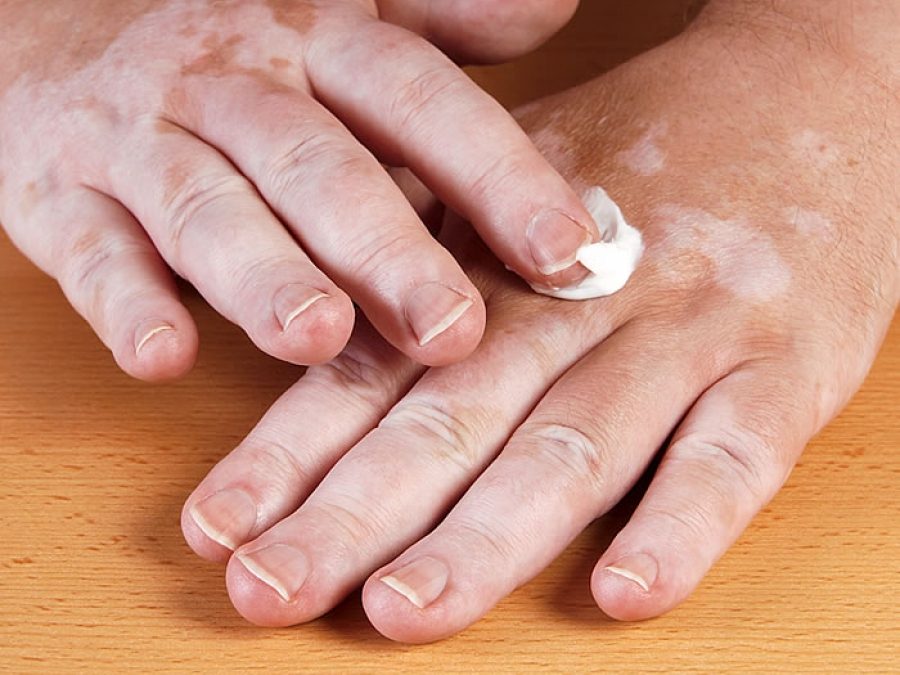 Vitiligo make-up: 10 Tips for successful application